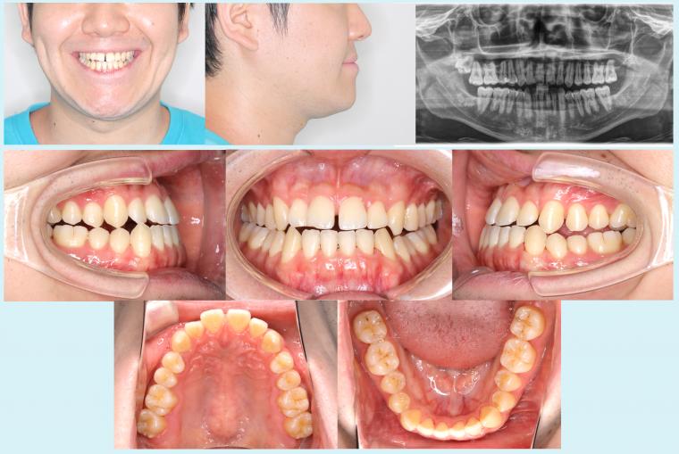 #46 下顎歯列の後方移動を行った症例