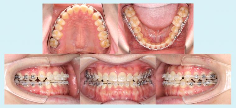 #46 下顎歯列の後方移動を行った症例