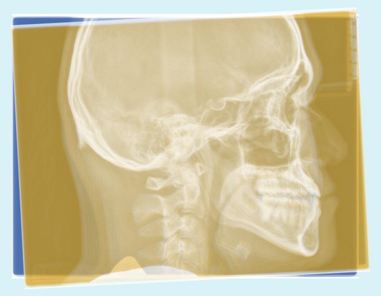 #46 下顎歯列の後方移動を行った症例