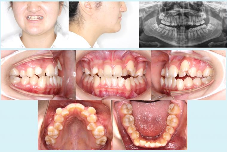 #44 上顎歯列の狭窄を伴う叢生症例