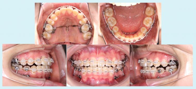 #44 上顎歯列の狭窄を伴う叢生症例