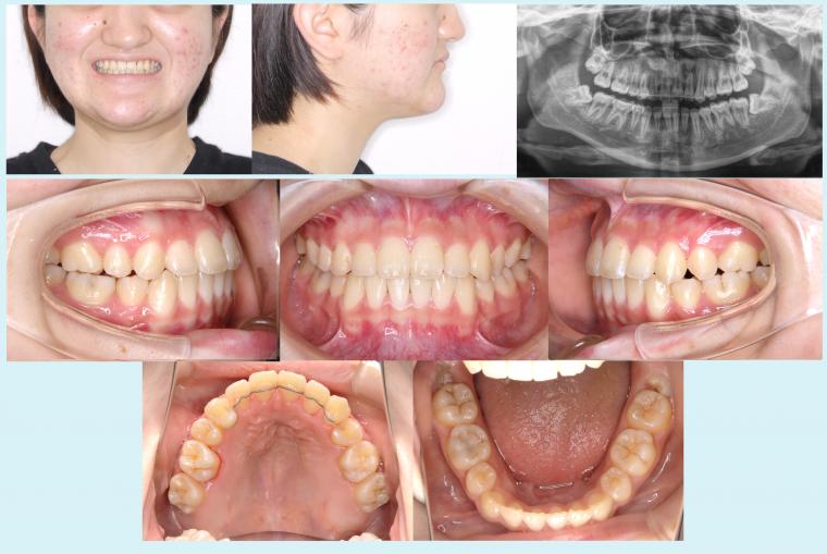 #44 上顎歯列の狭窄を伴う叢生症例