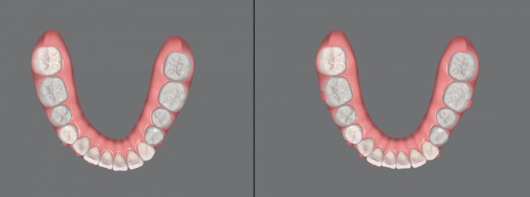 #45 軽度叢生を治療した症例