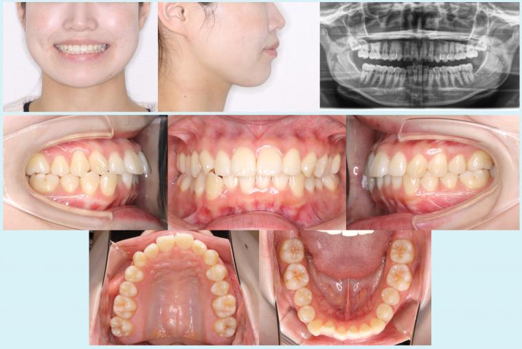 #45 軽度叢生を治療した症例