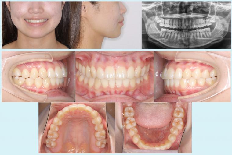 #45 軽度叢生を治療した症例