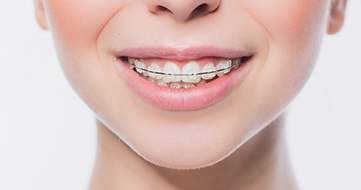 幅広い症例に対応できる表側矯正