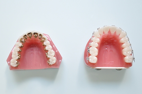 矯正治療はさまざまなタイプから選べます