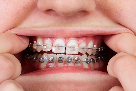 ブラケット矯正