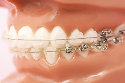 目立たない表側矯正とは