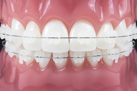 クリアブラケット