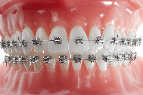 メタルブラケット