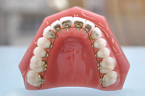 見えにくい舌側矯正とは