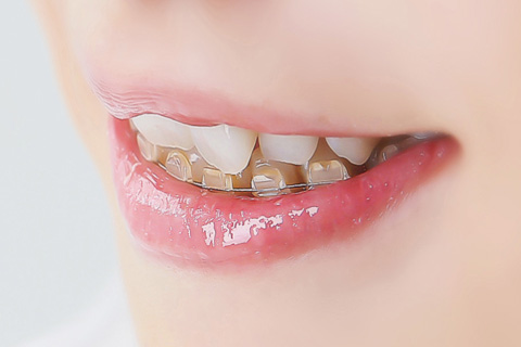 上顎は裏側に、下顎は表側に装置を付ける「ハーフリンガル」