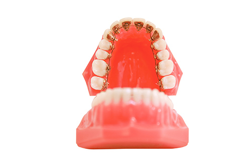 カスタムメイド型リンガルブラケット矯正装置(インコグニート)とは