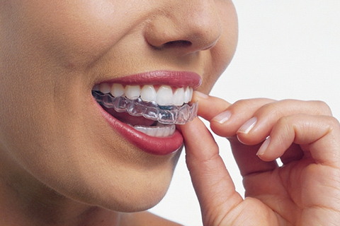 インビザライン・システム(invisalign®)とは
